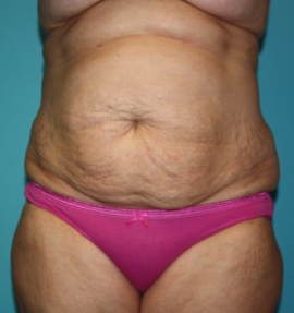 tummy-tuck-6-1b Before