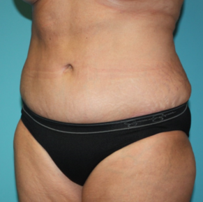 tummy-tuck-6-2a After