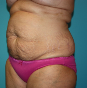 tummy-tuck-6-2b Before