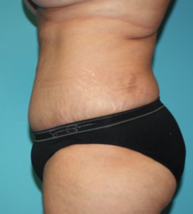 tummy-tuck-6-3a After