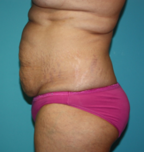 tummy-tuck-6-3b Before